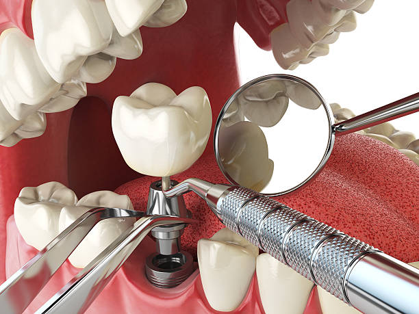 Best Emergency Dental Extractions in Point Venture, TX